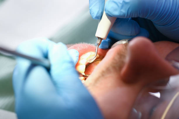 Best Emergency Dental Care for Broken or Chipped Teeth in Snellville, GA